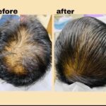 What is the best treatment for hair loss? What is the best treatment for hair loss?